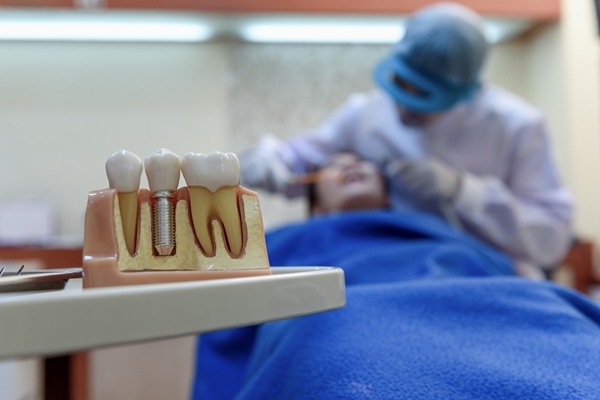Can All My Teeth Be Replaced With Implants?